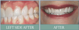 Smile results 17 Smile results
