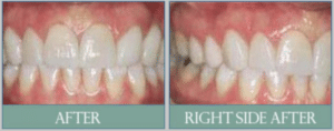 Smile results 18 Smile results