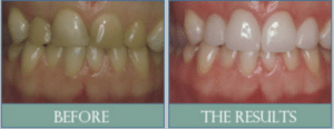 Smile results 24 Lumineers