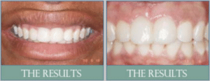 Smile results 15 Screen shot 2018 11 20 at 2. 03. 46 pm
