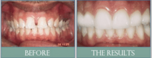 Smile results 2 Smile results