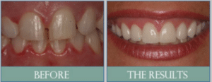 Smile results 5 Screen shot 2018 11 20 at 2. 30. 27 pm