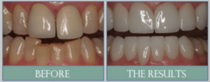 Smile results 4 Smile results