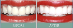 Smile results 7 Smile results