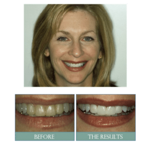 Smile results 22 Smile results