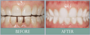 Smile results 9 Smile results