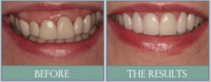 Smile results 23 Gummysmile