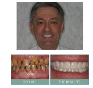 Smile results 20 Smile results