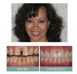 Smile results 21 Smile results