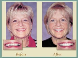 Smile results 19 Smile results