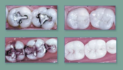 Smile results 12 Original fillings