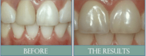 Smile results 11 Smile results