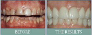 Smile results 25 Wornteeth