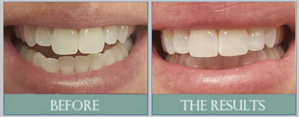 Smile results 27 Hooper before and after veneers