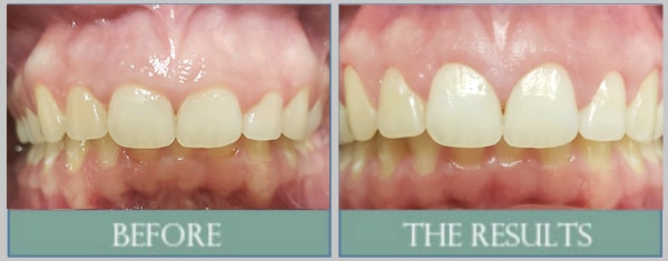 Smile results 26 Hooper beforeafter