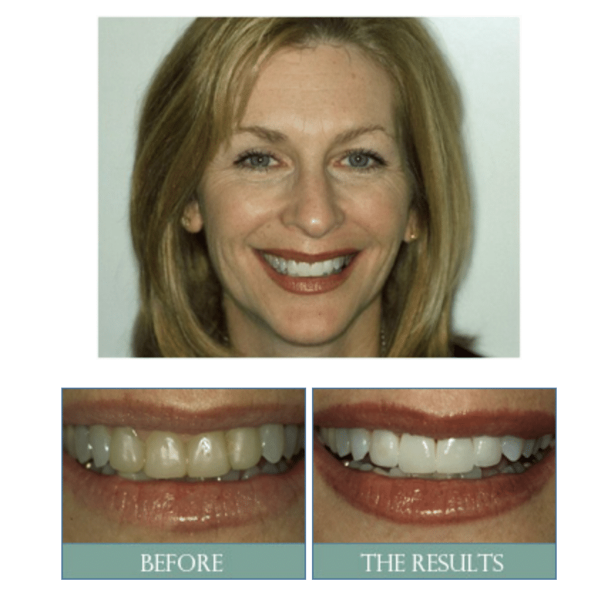 before and after Hooper Dentistry