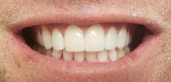 Hooper dentistry cosmetic 2 Hooper dentistry