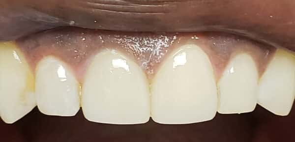 Hooper dentistry cosmetic 3 Hooper dentistry