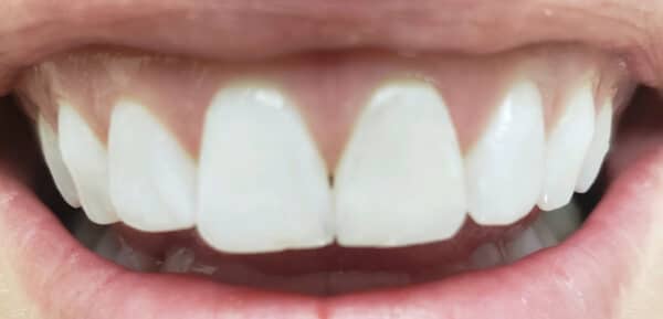 Hooper dentistry cosmetic 4 Hooper dentistry