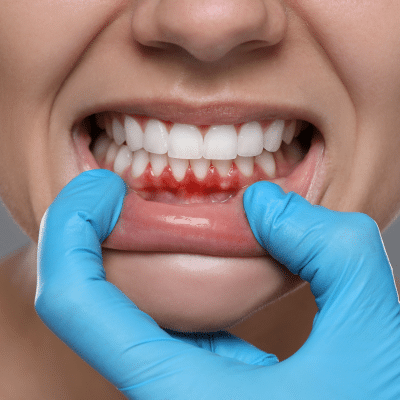 Gum disease prevention: symptoms, treatments and how to protect your gums 2 A person with a sore on their lips, representing gum disease prevention