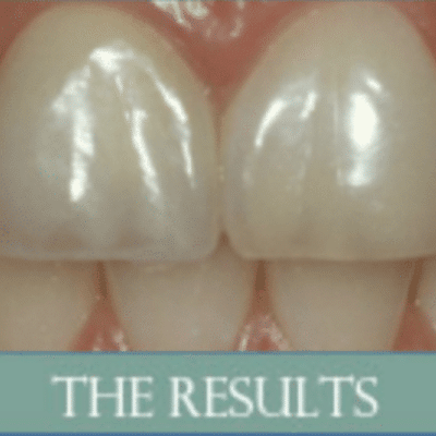 How long do porcelain veneers last? + tips for maintaining porcelain veneers 2 After results of porcelain veneers at hooper general & cosmetic dentistry, representing tips for maintaining porcelain veneers