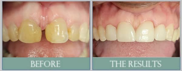 Smile results 28 Before and after dental crown results showing cosmetic dentistry restoration by hooper general & cosmetic dentistry in virginia beach, va